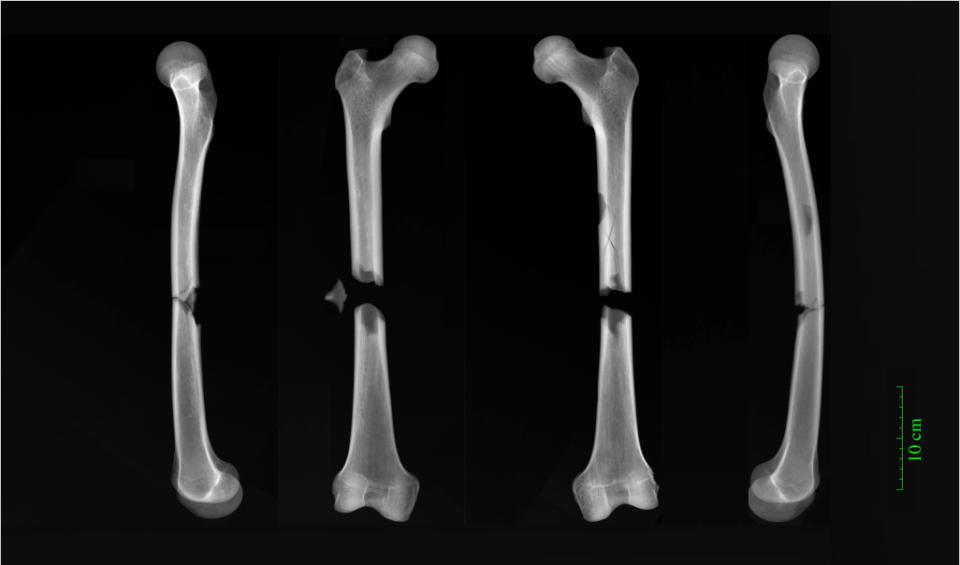 X-rays of butterfly fractures to both femora of an adult male 