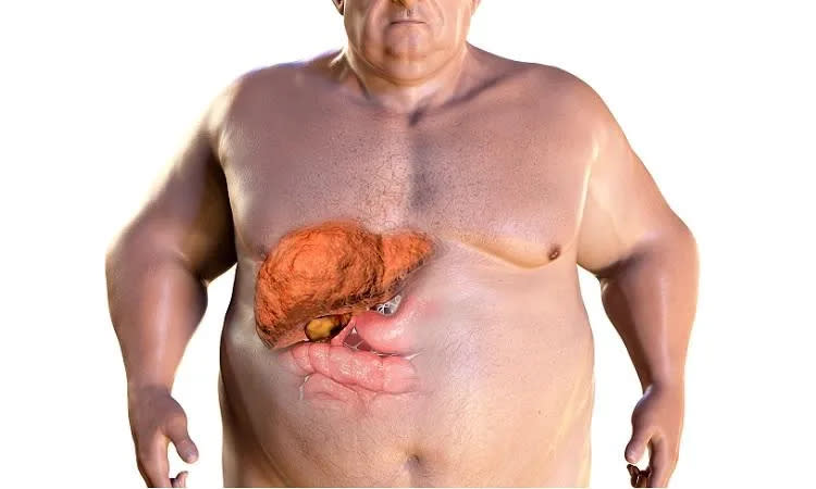<strong>一名55歲女子有重度脂肪肝及腎結石問題。（示意圖／pixabay）</strong>