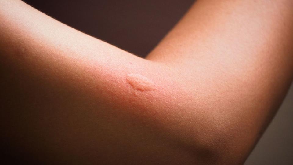 <p><strong>What it looks like:</strong> <a href="https://www.prevention.com/health/g22071372/how-to-get-rid-of-mosquito-bites/" rel="nofollow noopener" target="_blank" data-ylk="slk:Mosquito bites;elm:context_link;itc:0;sec:content-canvas" class="link ">Mosquito bites</a> present as small, puffy, round bumps that are lighter or redder than the surrounding skin. Bites often center around ankles, hairlines, and the backs of knees and necks, and they’re likely to be isolated—not part of a cluster (unless you were hanging out in prime mosquito territory during dawn or dusk).</p><p><strong>Symptoms to note:</strong> As you most likely know, mosquito bites are painless at first, then <a href="https://www.prevention.com/health/a20481496/this-is-why-mosquitoes-love-you/" rel="nofollow noopener" target="_blank" data-ylk="slk:very, very itchy;elm:context_link;itc:0;sec:content-canvas" class="link ">very, very itchy</a>. Some people suffer from “skeeter syndrome,” which causes the bites to grow into painful, <a href="https://www.prevention.com/health/a20469490/mosquito-bite-reaction/" rel="nofollow noopener" target="_blank" data-ylk="slk:swollen welts;elm:context_link;itc:0;sec:content-canvas" class="link ">swollen welts</a>. Mosquitoes do carry a risk of certain diseases like <a href="https://www.prevention.com/health/a32781159/west-nile-virus-symptoms/" rel="nofollow noopener" target="_blank" data-ylk="slk:West Nile;elm:context_link;itc:0;sec:content-canvas" class="link ">West Nile</a> and Zika, so monitor for cold- or flu-like symptoms after a bite.</p><p><strong>RELATED: <a href="https://www.prevention.com/health/g20513318/stop-mosquito-bites/" rel="nofollow noopener" target="_blank" data-ylk="slk:How to Prevent Mosquito Bites;elm:context_link;itc:0;sec:content-canvas" class="link ">How to Prevent Mosquito Bites</a></strong></p>