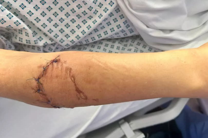 Aysha Rose was left with horrific injuries after a dog charged at her outside a Tesco Express in Blackburn and sank its teeth into her arm
