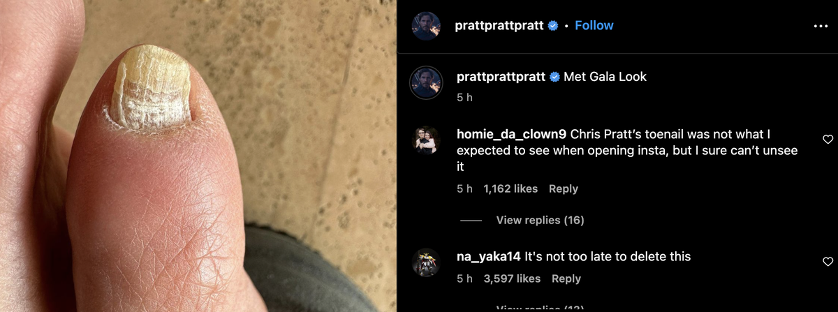 Chris Pratt’s crusty toenail (Instagram)