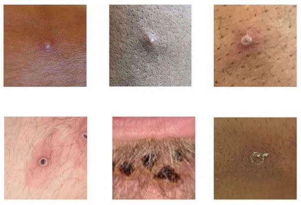 PHOTO: Examples of rashes and lesions caused by the monkeypox virus are seen in this handout image obtained from official Centers for Disease Control and Prevention (CDC) website on July 1, 2022.  (UK Health Security Agency/CDC via Reuters)