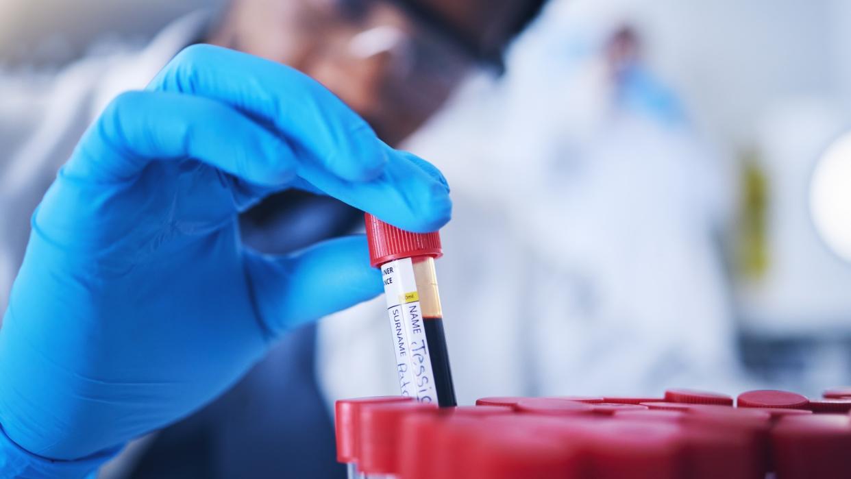  Close-up of a scientist picking up a test tube with a red lid containing blood. The scientists' hand is in focus and they are wearing blue gloves. The test tube is picked up from amongst what looks like a group of tubes, where the red tops are only visible. The scientists blurred face is shown in the background. They are wearing goggles. . 