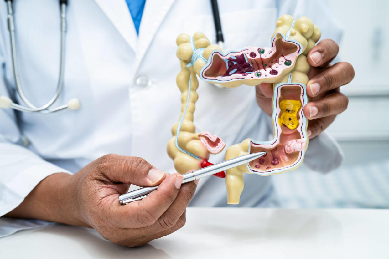 Doctor holding a colon anatomy model for study (Sasirin Pamai / Getty Images)