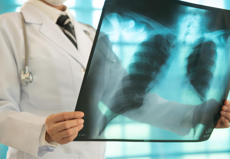 doctor radiology looking chest x-ray film of patient at hospital. In pulmonary edema, fluid collects in the many air sacs in the lungs, making it difficult to breathe. (Getty)