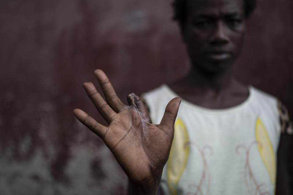 Lenlen Desir Fondala shows her hand that is missing a finger shot off by a stray bullet during a gang attack while she was living in Cite Soleil, as she stands in Jean-Kere Almicar’s front yard where she is seeking refuge, in Port-au-Prince, Haiti, Sunday, June 4, 2023. (AP Photo/Ariana Cubillos)