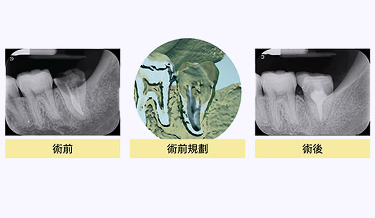 <strong>張紘銘醫師說明，病人術後恢復咀嚼功能，並經追蹤15個月，經臨床及X光檢查後，移植牙皆無異狀。（圖／新竹臺大分院提供）</strong>