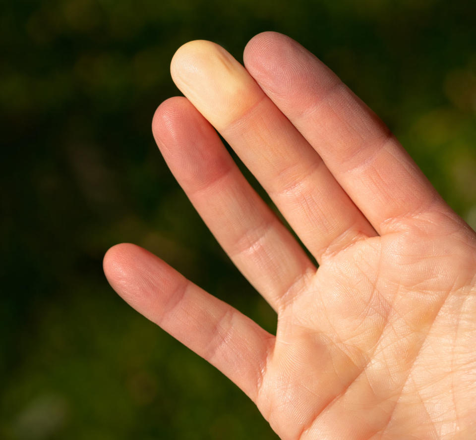 Fingers with Raynauds syndrome. (Petra Richli / Getty Images/iStockphoto)
