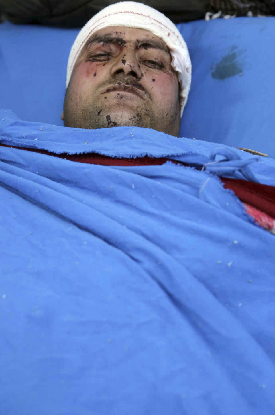 A wounded man lies on a bed in a hospital in Kabul, Afghanistan, Monday, Jan. 14, 2019. Afghan officials say multiple people were killed when a suicide bomber detonated a vehicle full of explosive in the capital Kabul on Monday. (AP Photo/Massoud Hossaini)