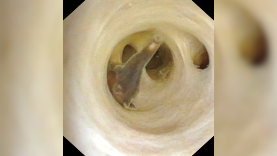 Still image of a video that doctors captured of inside the man's abdomen showing one of the brown liver flukes