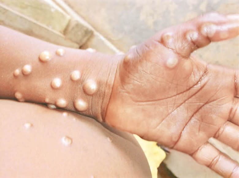 猴痘疫情在全球蔓延。
