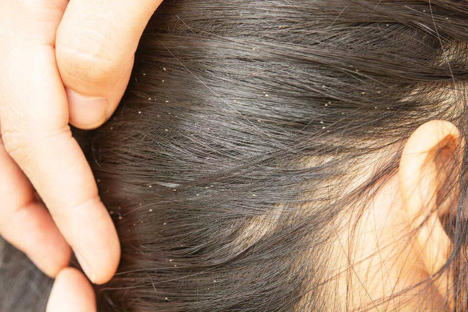 Lice in hair. (Srisakorn / Getty Images)