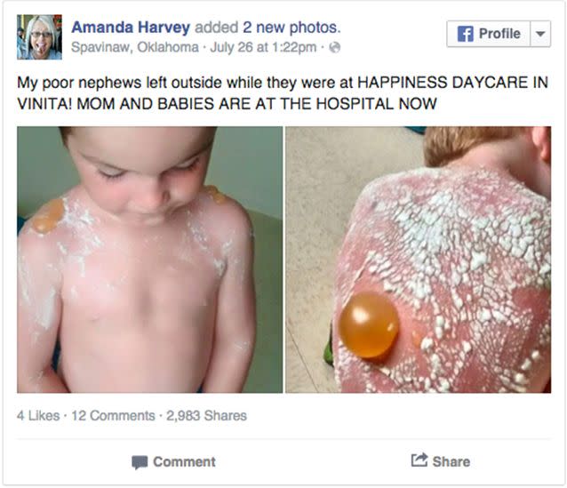 Ms Broadway and her family posted family members posted photos of the boys' severe burns to Facebook slmming the child care centre. Facebook/amanda.harvey