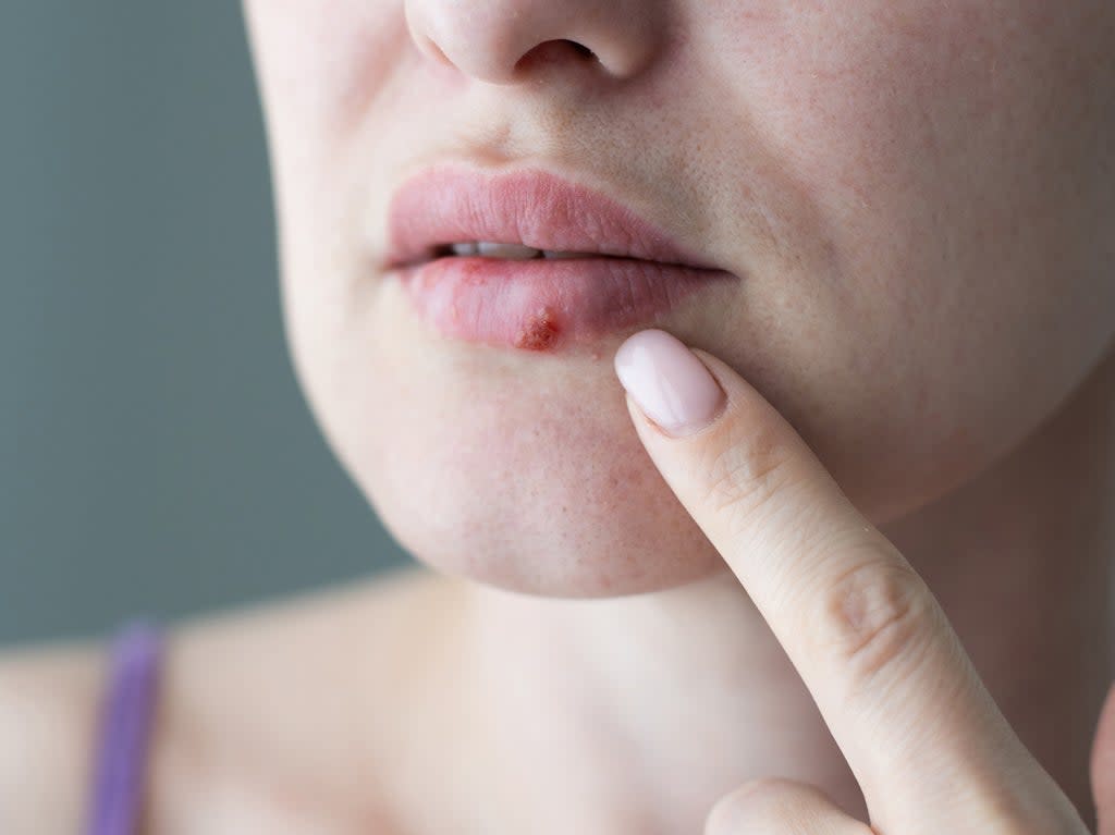 Cold sores are caused by the herpes virus  (Getty Images/iStockphoto)