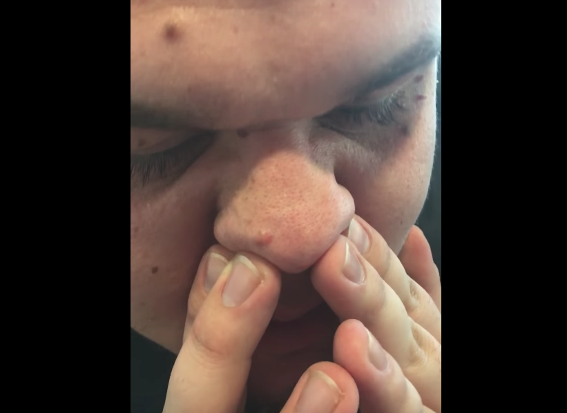 Over 1 million people have watched this video of a man popping all his blackheads
