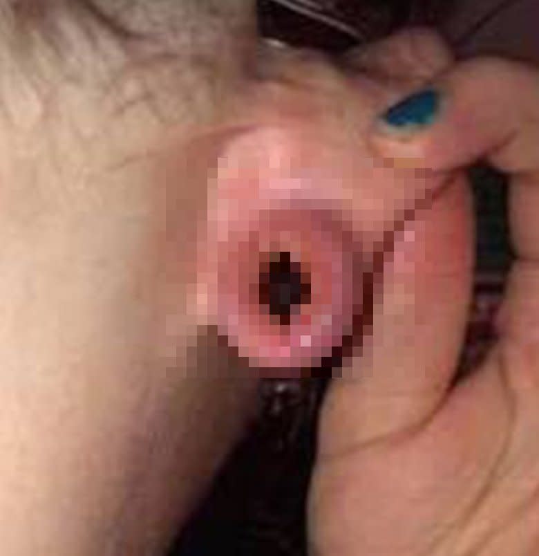 一名美國女子被男友用「下體」戳自己的耳洞導致發炎。（圖／翻攝自臉書）
