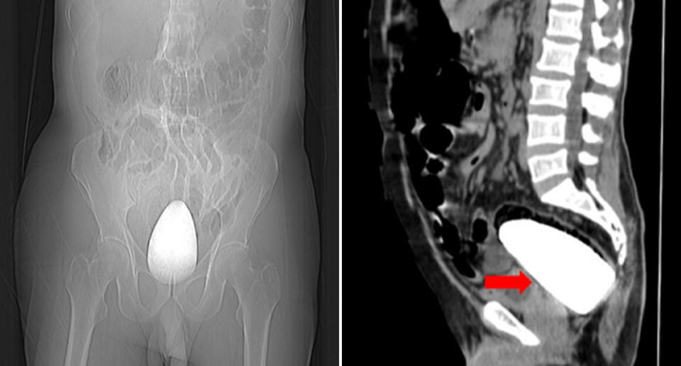 A CT scan and an X-ray show a ceramic pestle lodged in the rectum of an 80-year-old man.