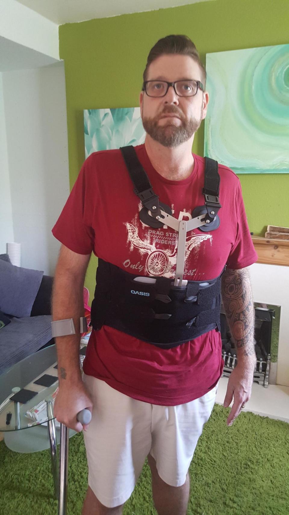 Since the attack Tom has been confined to crouches and must wear a back brace for six months. (Tom Barwick)