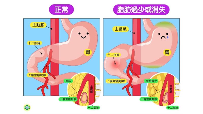 <strong>上腸繫膜動脈症候群是罕見的上消化道阻塞疾病。（國泰綜合醫院提供）</strong>