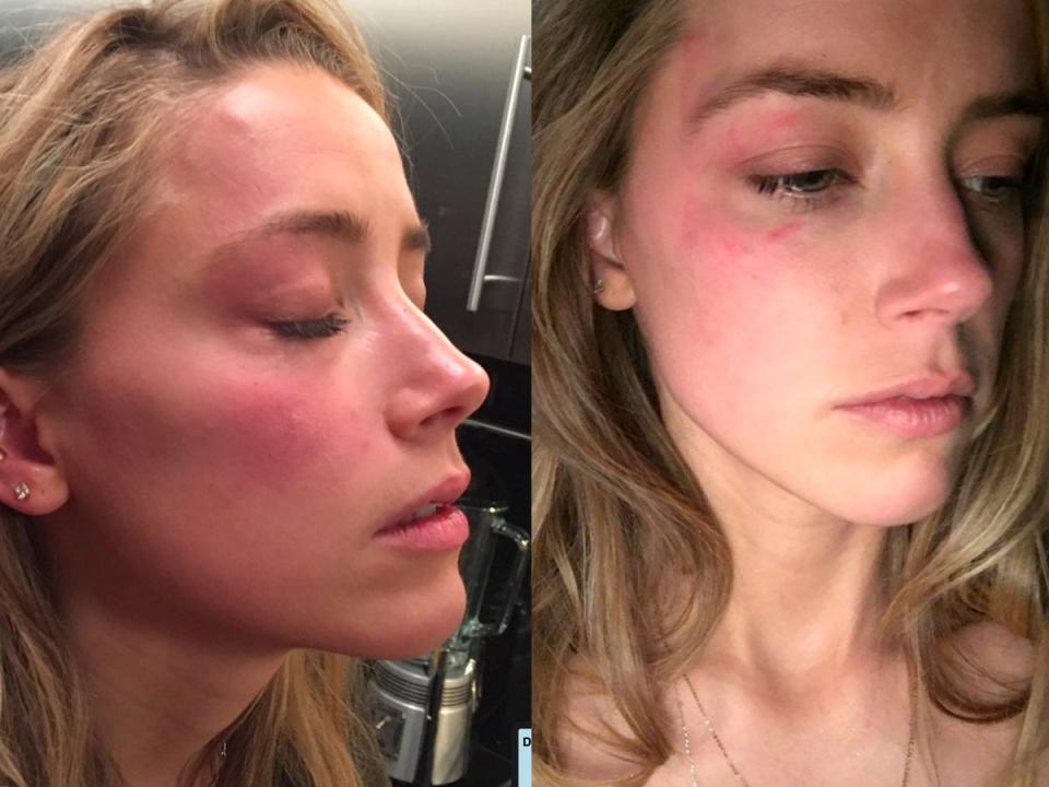 Amber Heard is seen with red bruises on her face in photos entered into evidence by her lawyers in her defamation trial against her ex-husband Johnny Depp