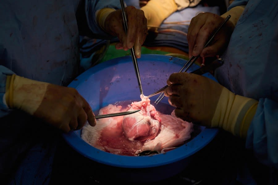 In this photo provided by NYU Langone Health, surgeons prepare a genetically modified pig heart for transplant into a recently deceased donor at NYU Langone Health on Wednesday, July 6, 2022, in New York. Experiments are raising new hope that pigs might one day help fill a shortage of donated organs — at least, for people who need a new heart or kidney. (Joe Carrotta/NYU Langone Health via AP)