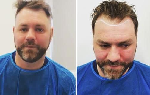 Brian McFadden has unveiled he underwent a hair transplant. Source: Instagram / @brianmcfadden123