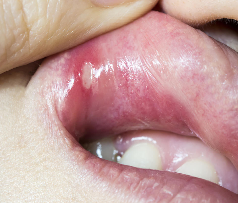 Mouth ulcer, canker sore, canker sore on lip, how to get rid of canker sores (Getty Images)