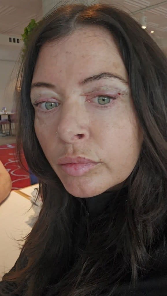 Gemma Gilfoyle, 39, spent $1.5K on surgery to have her upper eyelids partially removed – so she can apply eyeliner properly. Gemma Gilfoyle / SWNS
