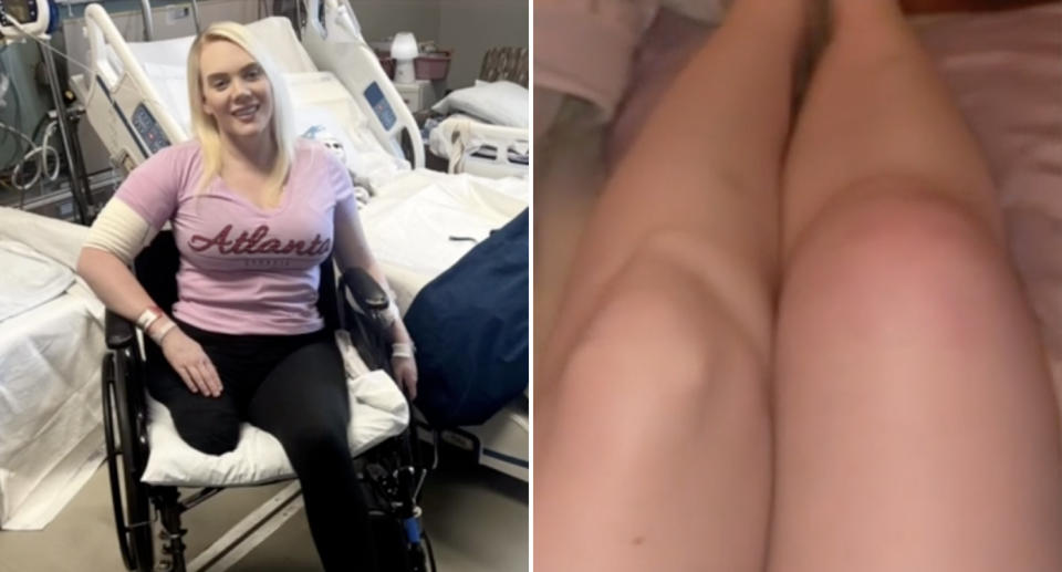 Jennifer Barlow with her leg amputated sitting in a wheelchair in hospital. Right is her swollen and red right left compared to her normal left leg.