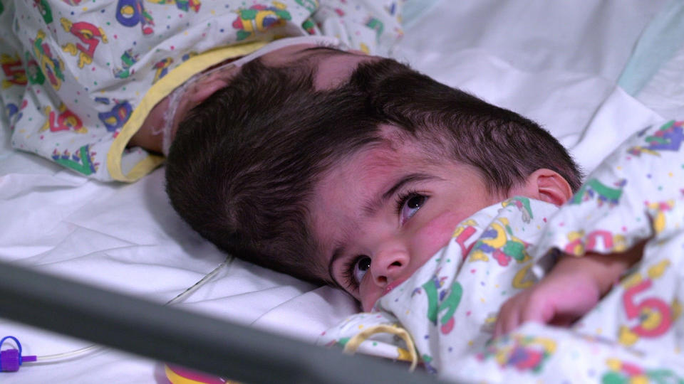 Undated handout photo issued by Great Ormond Street Hospital of two-year-olds Safa and Marwa Ullah, from Charsadda in Pakistan, before a surgery to separate their heads at the hospital in London. PRESS ASSOCIATION Photo. Issue date: Monday July 15, 2019. The sisters, who were craniopagus twins, underwent three major operations to separate their heads at Great Ormond Street. The last operation, which saw the girls finally separated, took place on February 11 this year. See PA story HEALTH Twins. Photo credit should read: Great Ormond Street Hospital/PA Wire  NOTE TO EDITORS: This handout photo may only be used in for editorial reporting purposes for the contemporaneous illustration of events, things or the people in the image or facts mentioned in the caption. Reuse of the picture may require further permission from the copyright holder. 