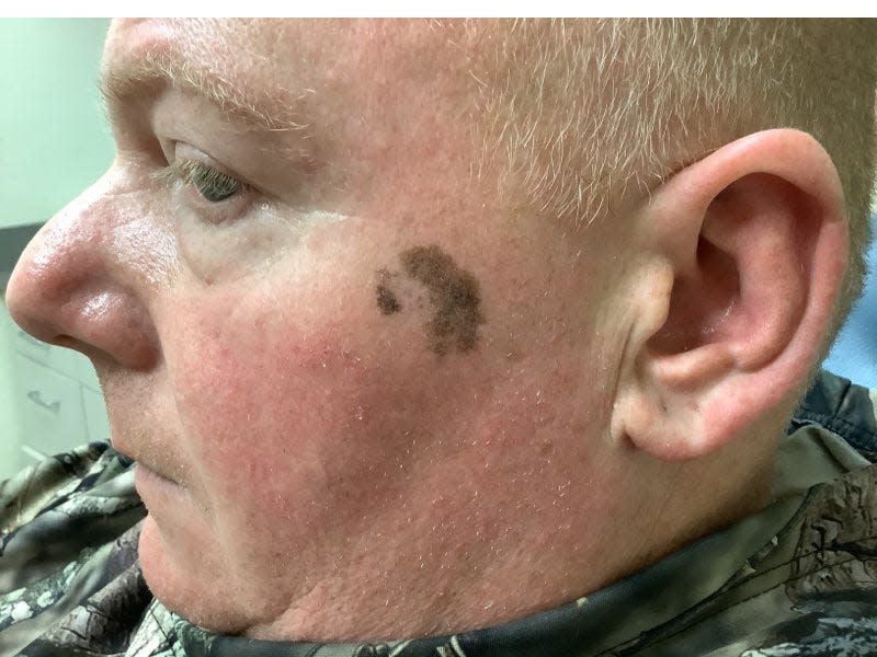 Chris Meffen, pictured with what turned out to be a sign of early-stage melanoma.