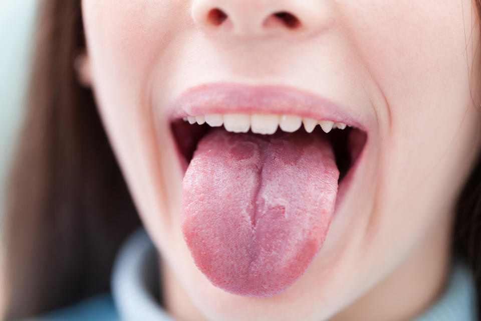 La lengua geográfica presenta manchas rojas que no duelen, pero que parecen cambiar de lugar. Esta afección es inofensiva. (Getty Creative)