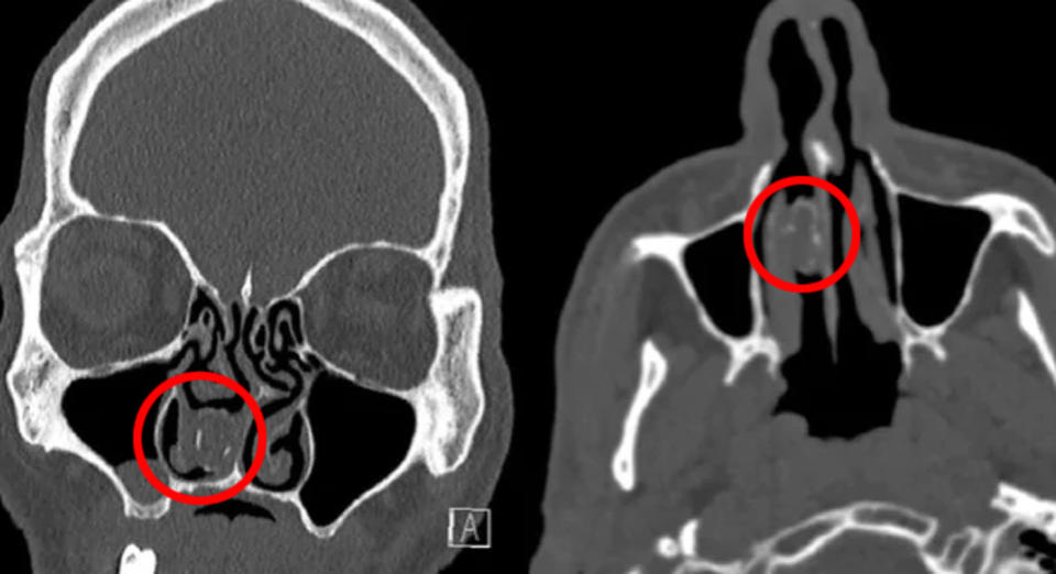 An X-ray shows a marijuana capsule lodged in a man's nose.