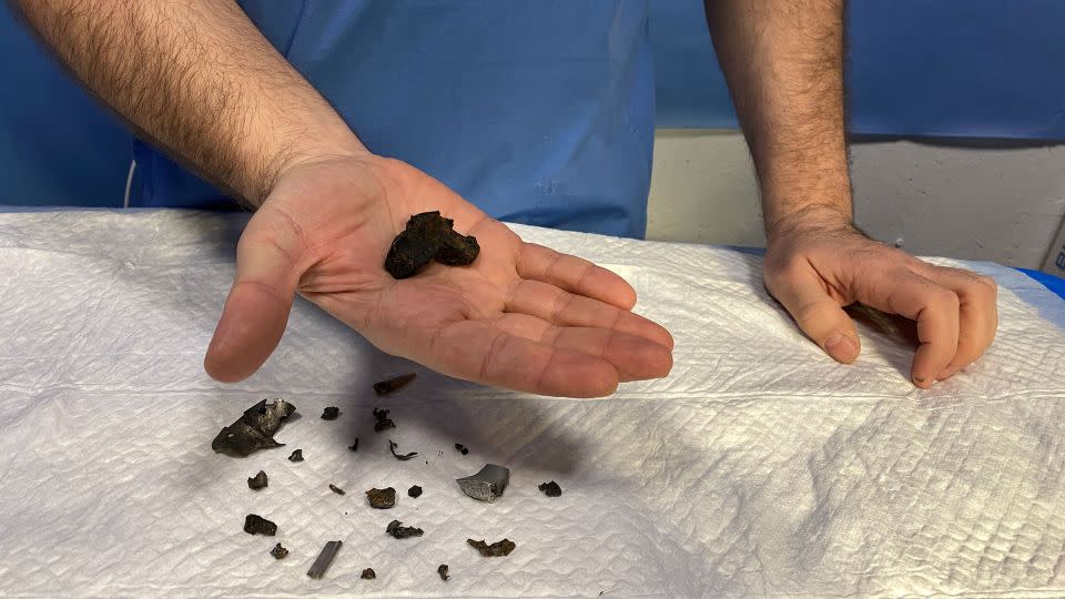 Mykytiuk shows CNN fragments of shrapnel he removed from the bodies of wounded Ukrainian soldiers. - Ivana Kottasová/CNN