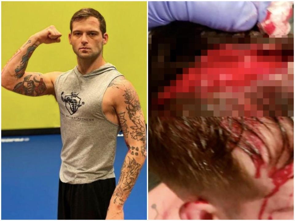 Hunter Boone suffered a horrible injury in his last amateur fight.