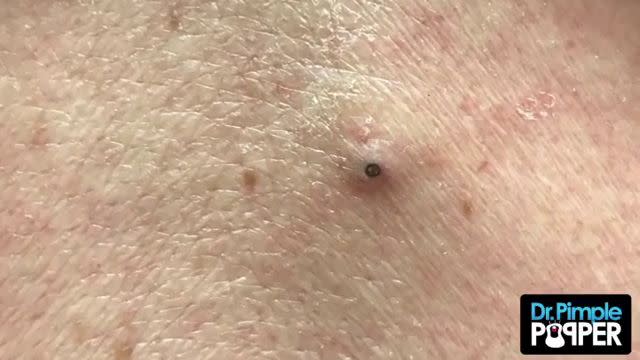 Dr. Pimple Popper -- Monster Blackhead Is So Painful It Needs