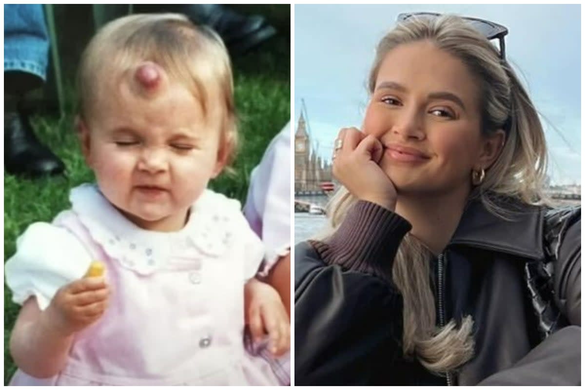 Molly-Mae Hague has discussed the large strawberry birthmark she had removed as a child (ES Composite)