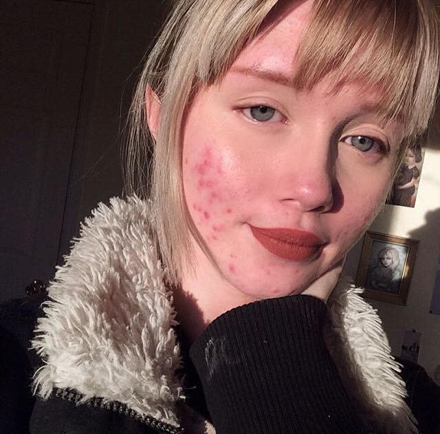 Hailey Wait’s empowering message about living with acne is something we all need to hear. (Photo courtesy of Hailey Wait)