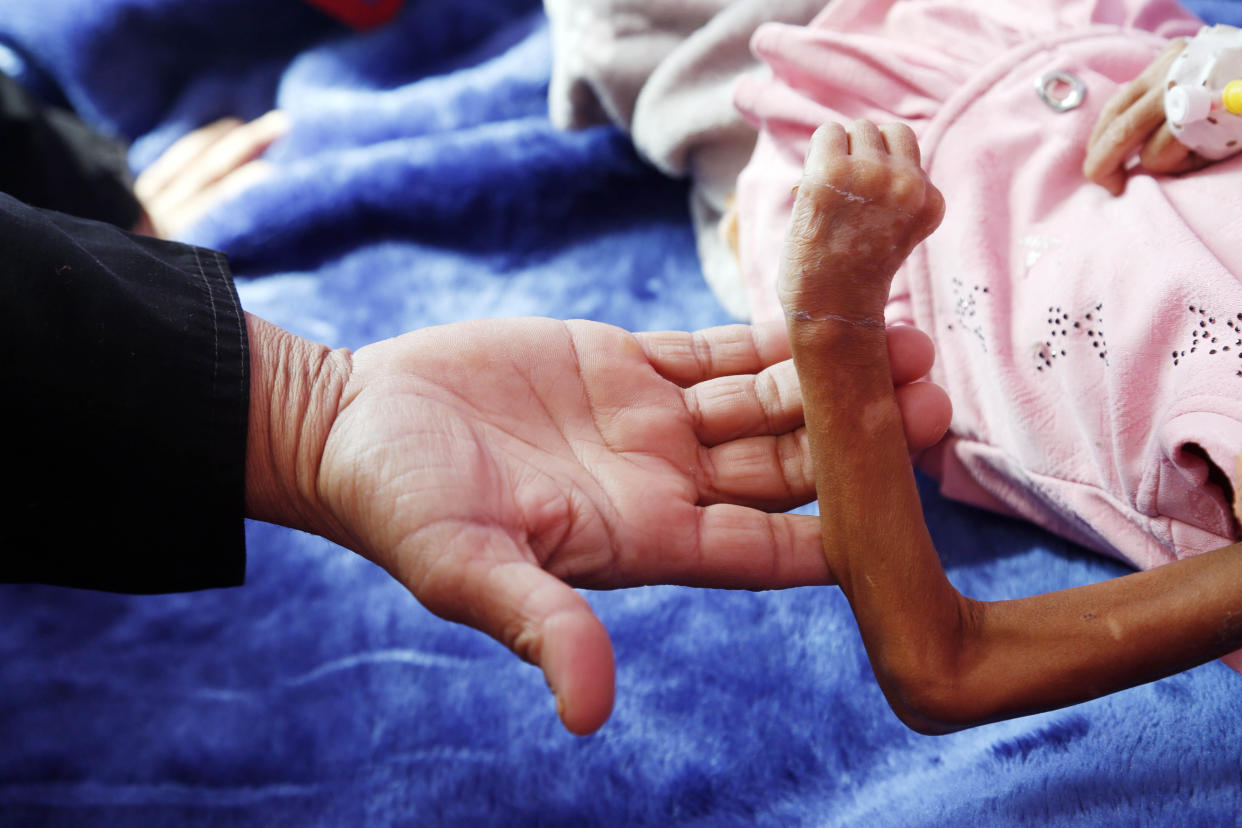 A Yemeni child suffering from malnutrition receives treatment with limited resources in 2022.