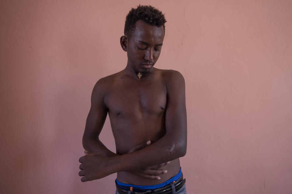 Berhane Gebrewahid, a 24-year-old Tigrayan farmer who fled the conflict in Ethiopia's Tigray, stands for a portrait in eastern Sudan, near the border with Ethiopia, on March 14, 2021, showing his gunshot wound from Amhara and Wolkait fighters seeking his cattle. Gebrewahid said he saw food aid being distributed in February 2021 by Amhara authorities. But it was refused to Tigrayans. "I saw this," he said. "It happened to me. First, they asked your ethnicity." Even the name of his homeland had changed, he said. "They called it Northern Gondar," after a major city in Amhara. (AP Photo/Nariman El-Mofty)