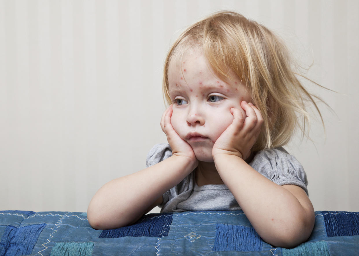 Parents are being advised to be on the lookout for the warning signs of measles, as an increased number of cases have been reported across the UK.