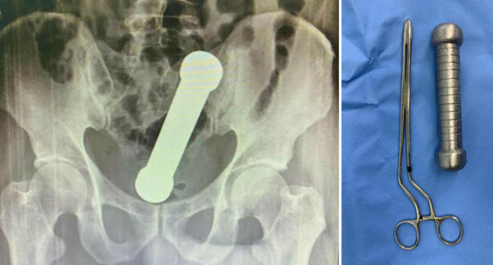 X-ray of the dumbbell in the man's rectum. 