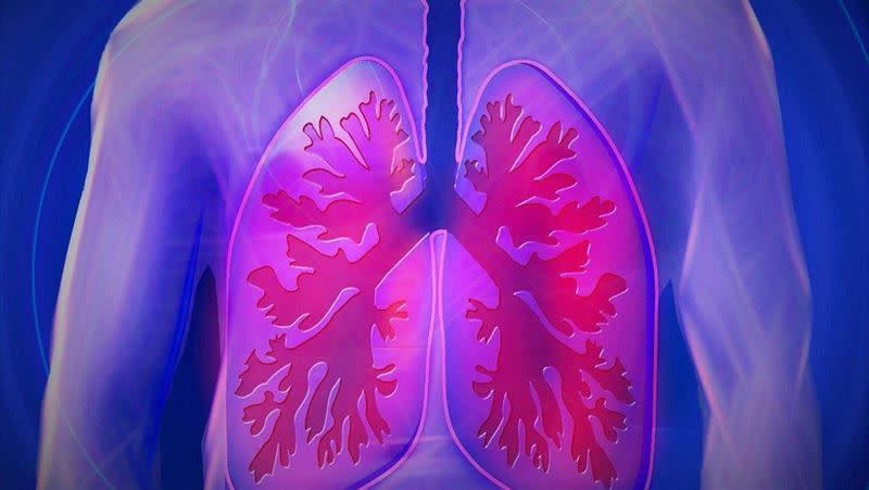 肺癌成為新國病。（示意圖／翻攝自pixabay）