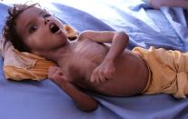 Un enfant souffrant de malnutrition allongé dans un lit d'hôpital dans la province de Hajjah, dans le nord-ouest du Yémen, le 25 octobre 2018