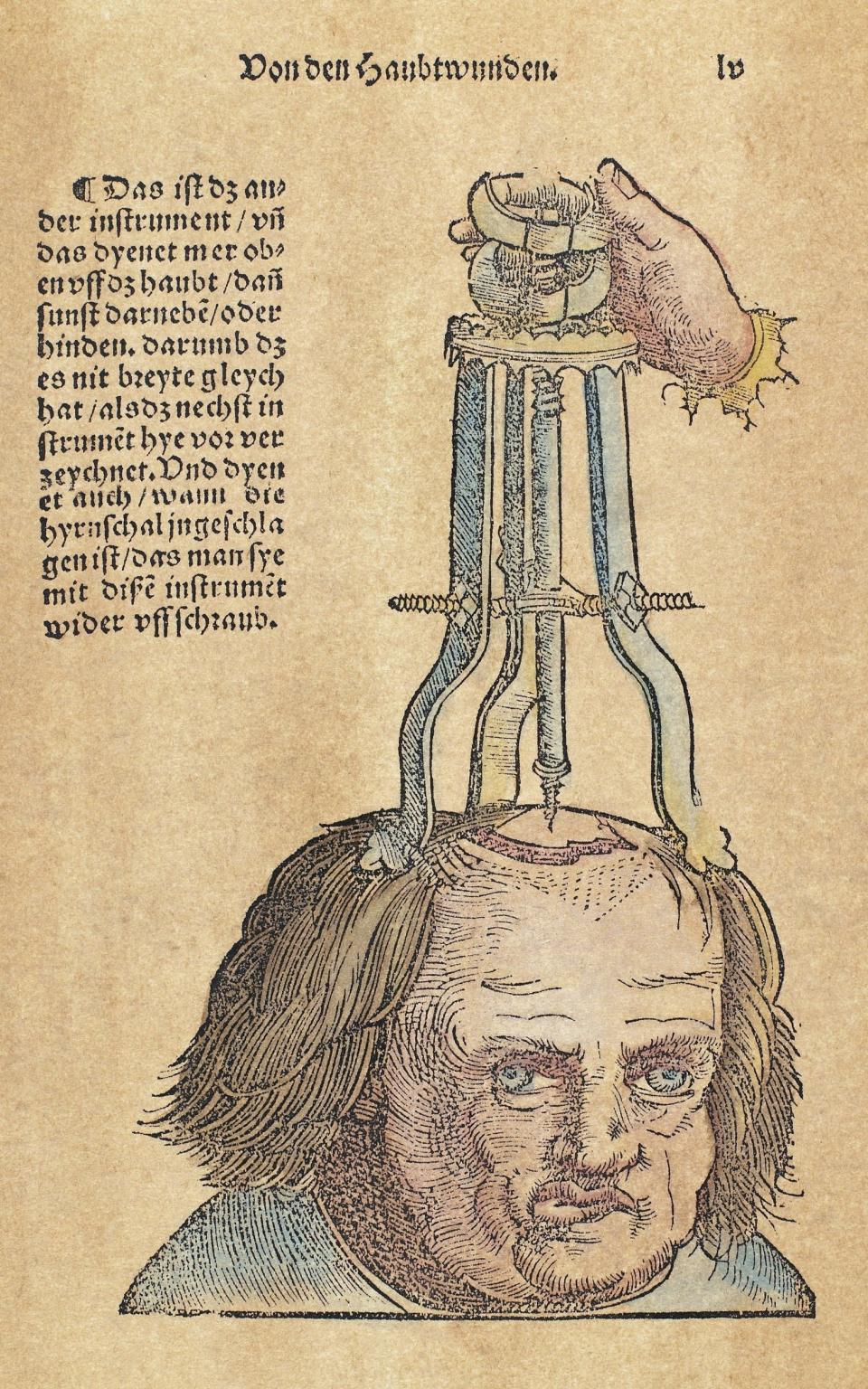 16th-century illustration of brain surgery