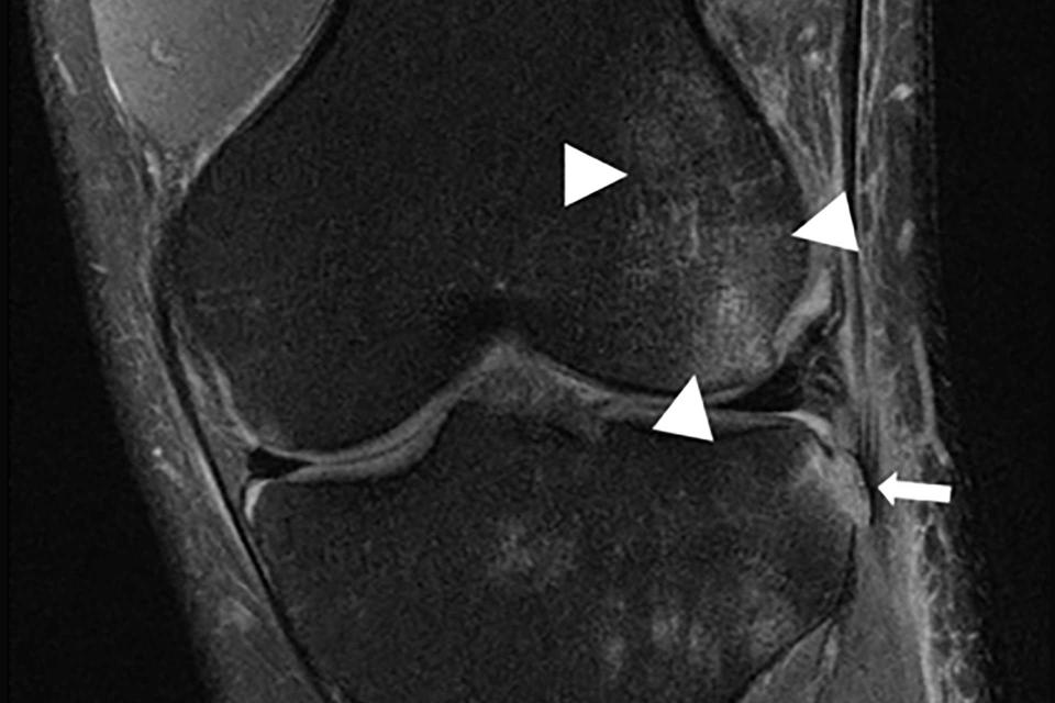 the triangles are pointing towards a hematoma and the arrow is noting a bone fracture.