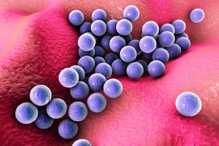 <span class="caption">Staphylococcus aureus can cause skin and respiratory infections, as well as food poisoning.</span> <span class="attribution"><a class="link " href="https://www.shutterstock.com/image-illustration/bacteria-staphylococcus-aureus-on-surface-skin-407372458?src=73e7fd33-427b-426f-a49f-1c175c44d41e-1-0" rel="nofollow noopener" target="_blank" data-ylk="slk:Kateryna Kon/ Shutterstock;elm:context_link;itc:0;sec:content-canvas">Kateryna Kon/ Shutterstock</a></span>