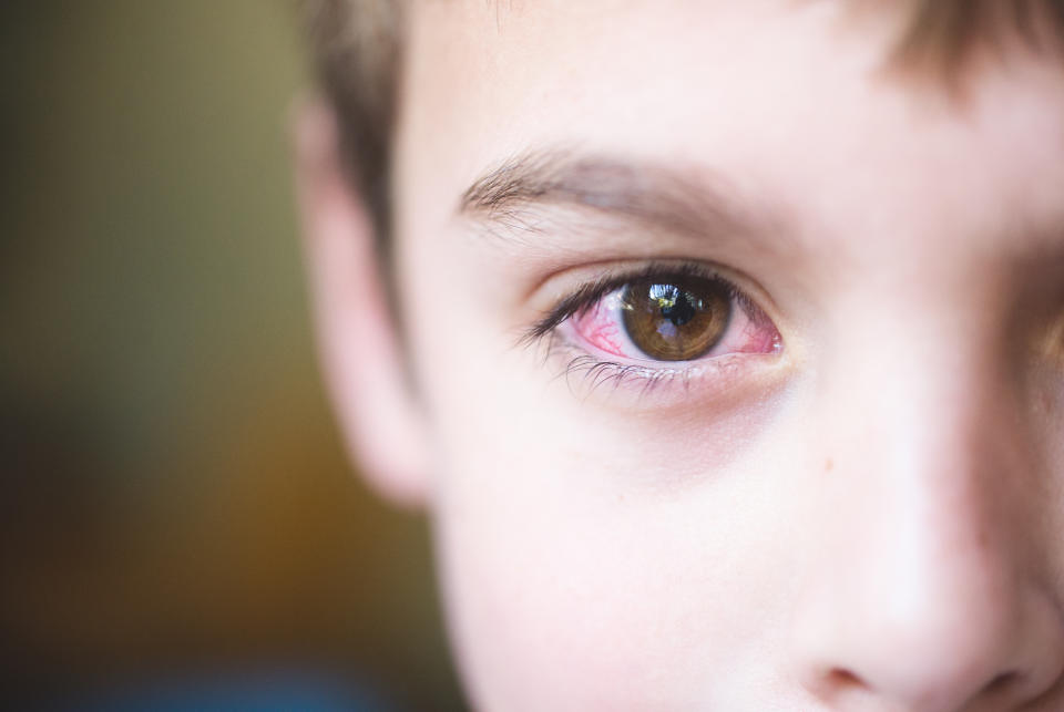 The Latest COVID Variant Is Causing This Bizarre Symptom in Kids