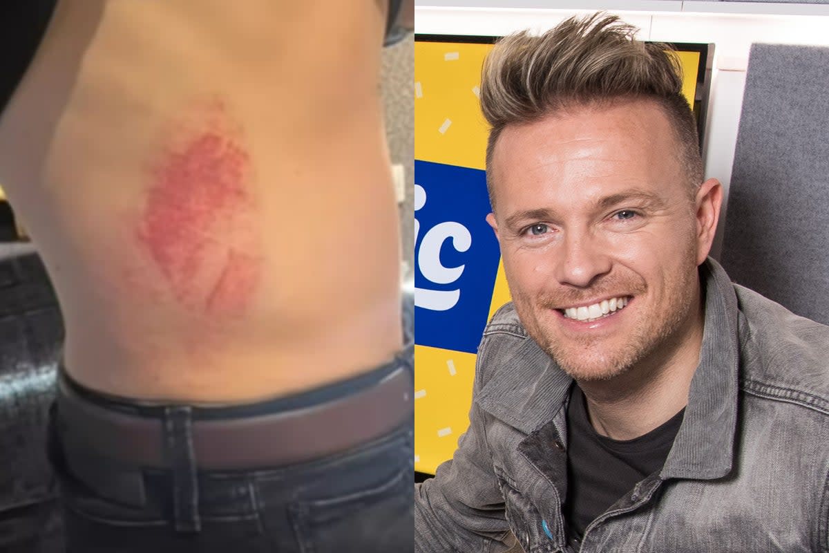 Nicky Byrne revealed his injuries on Instagram but insisted ‘the show must go on’  (Getty / Instagram)