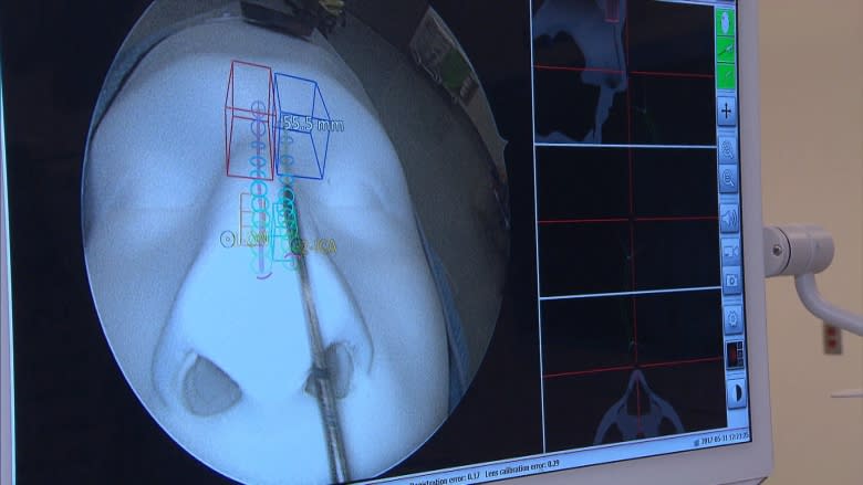 Montreal surgeon 1st in North America to use augmented reality technology on sinus patients